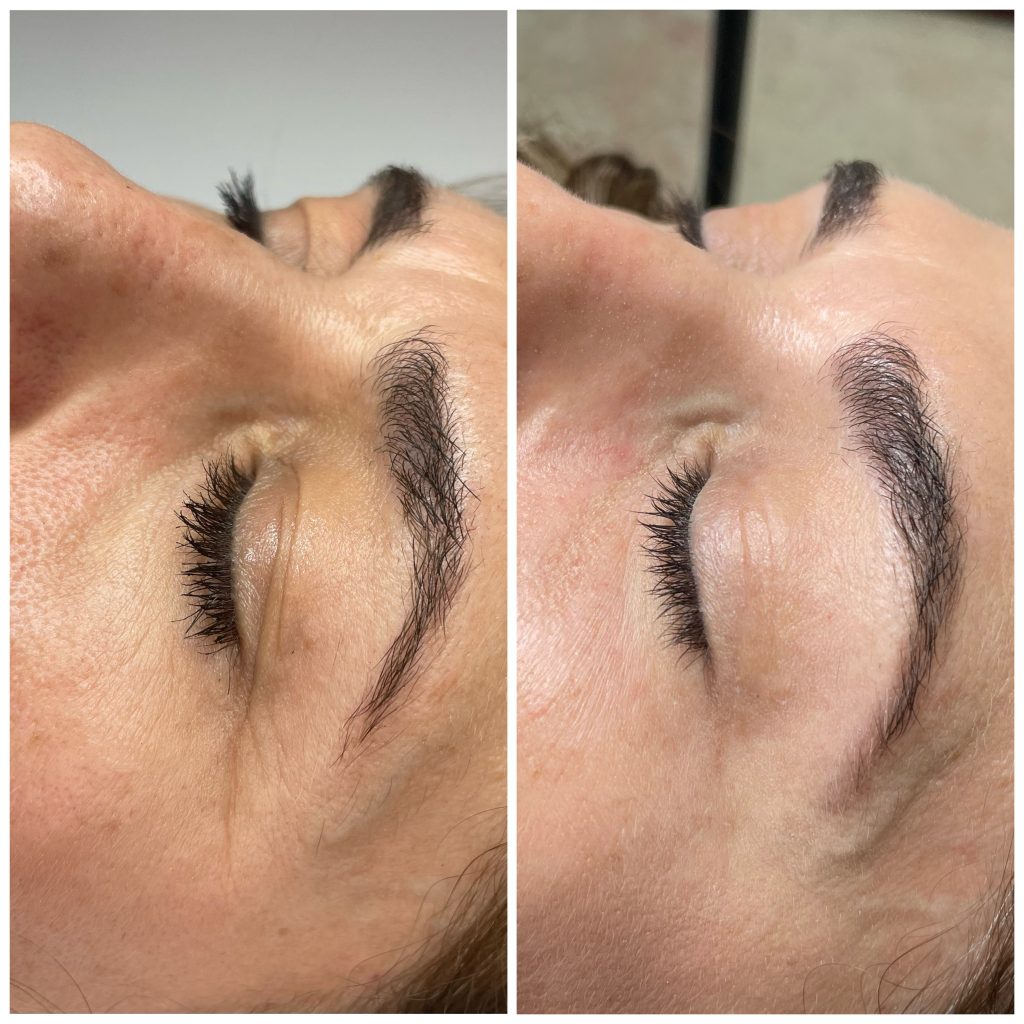 Blefaroplastia No Quirúrgica