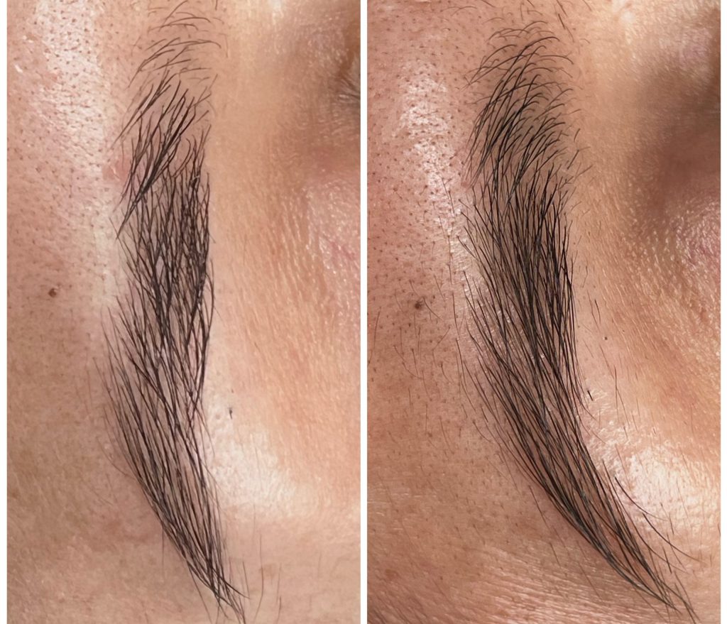 Rehabilitación Folicular de Cejas
